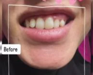 حالة علاج الابتسامة اللثوية قبل علاج الابتسامة اللثوية (Gummy Smile) — مركز الماسة لطب الجلد والتجميل بالشرقية