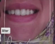نتيجة علاج الابتسامة اللثوية (Gummy Smile) بعد الجلسات (علاج الابتسامة اللثوية) — عيادة تجميل وجلدية بالشرقية مركز الماسة د. صفاء الجوهري