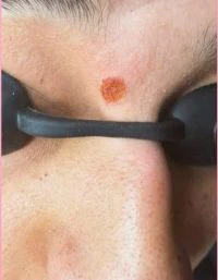نتيجة إزالة حسنة بالليزر بعد الجلسات (إزالة حسنة) — عيادة تجميل وجلدية بالشرقية مركز الماسة د. صفاء الجوهري